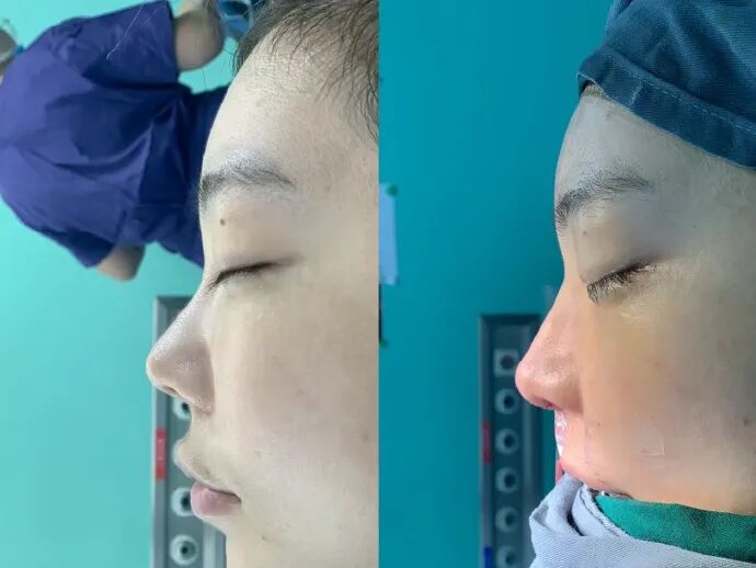 _整容鼻子知乎_整鼻子毁容