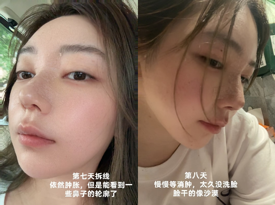 _整鼻子毁容_整容鼻子知乎